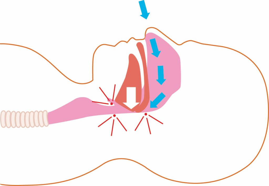 Obstrucción respiratoria