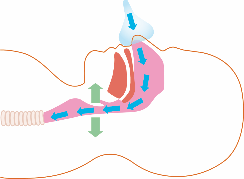 Respiración con CPAP: 